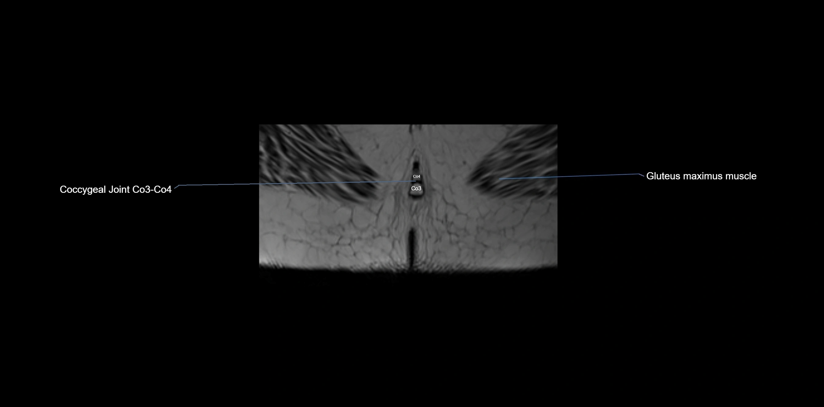 MRI sacrum, coccyx and sacroiliac joint axial cross sectional anatomy 3T  radiology  image-img-00001-00082.webp